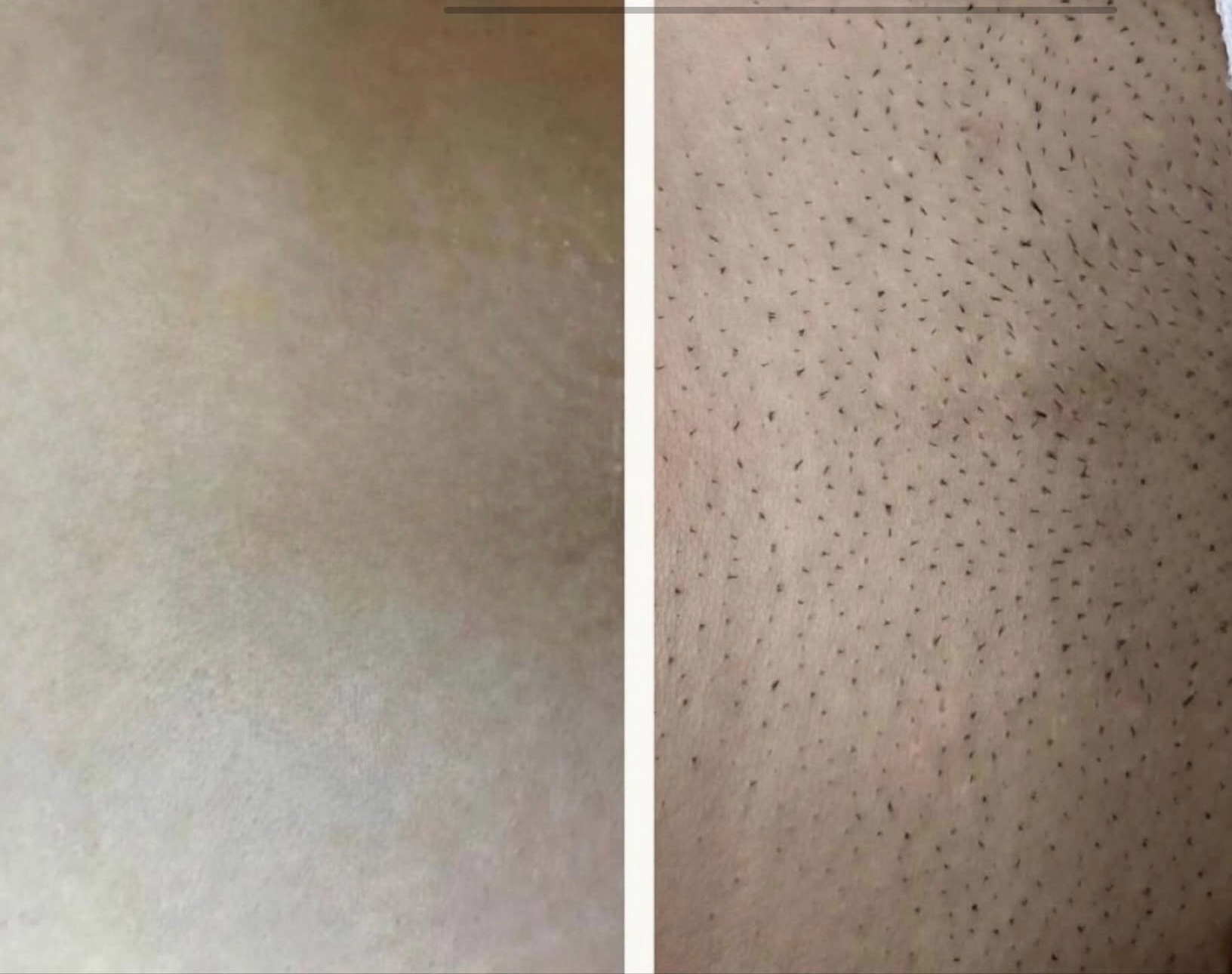 Resultaat laserontharing, zijdezachte huid